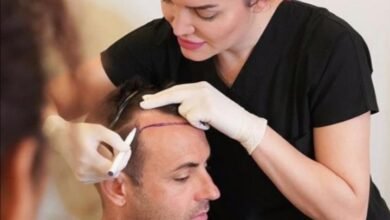 صورة توضيحية - مركز Estepera واحدث تقنيات زراعة الشعر العالمية