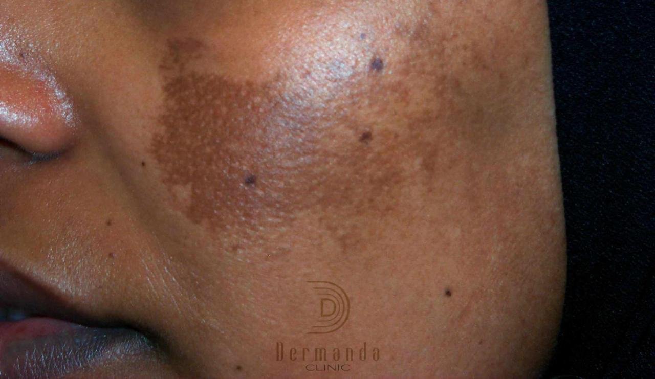 Dermanda Clinic إسم رائد في علاج الكلف بمختلف أنواعه - صورة مميزة صورة مميزة: Dermanda Clinic إسم رائد في علاج الكلف بمختلف أنواعه