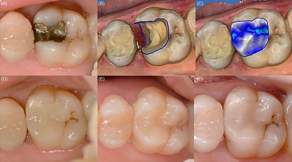 بين الماضي والحاضر الدكتور حبيب ظريفه يوضح عن آلية استخدام تقنية CAD/CAM Technology في طب الأسنان