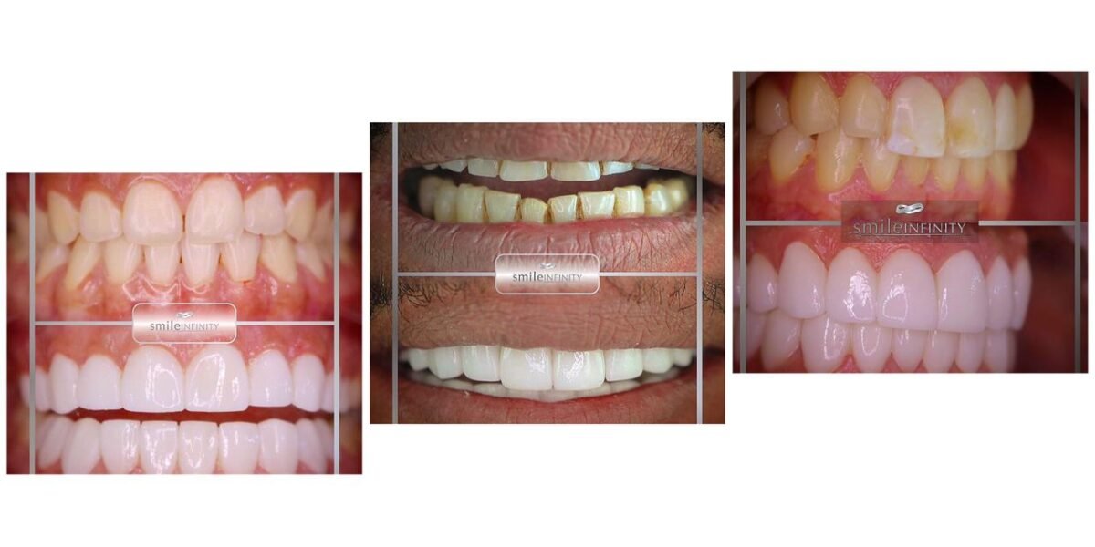 الدكتور Habib Zarifeh يقدم نصائح حول اختيار درجة اللون الأبيض Bleach المناسب لأسنان المريض - صورة مميزة صورة مميزة: الدكتور Habib Zarifeh يقدم نصائح حول اختيار درجة اللون الأبيض Bleach المناسب لأسنان المريض
